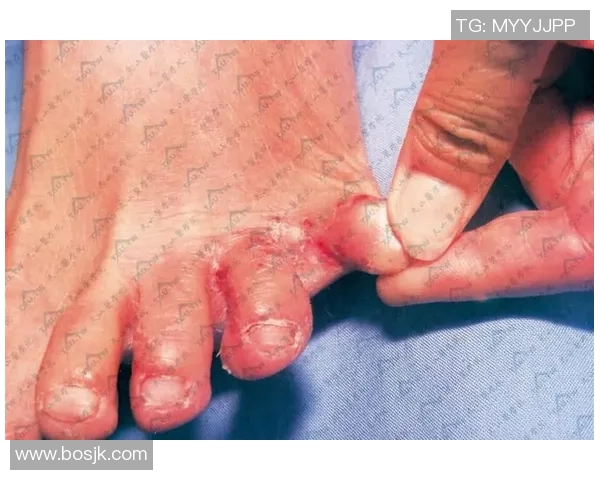 足球球星脚气困扰揭秘 哪些名将因脚气问题影响比赛状态